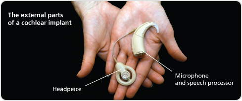 The external parts of a cochlear implant